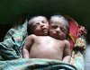 Из-за бедности родителей в Бангладеш умер двухголовый младенец